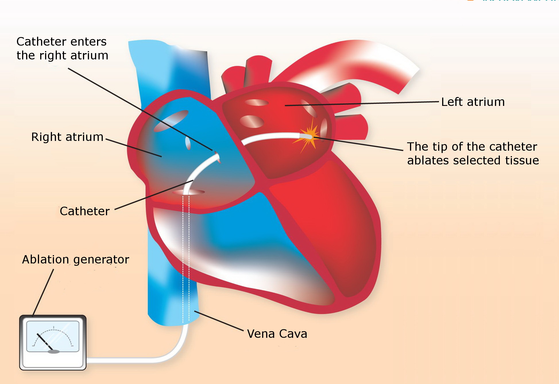 Cardiac Ablation Types, Preparations, Treatment & Risks