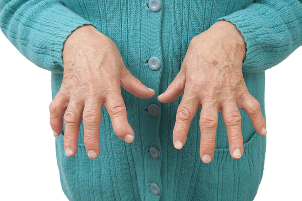 4.-Rheumatoid-Arthritis