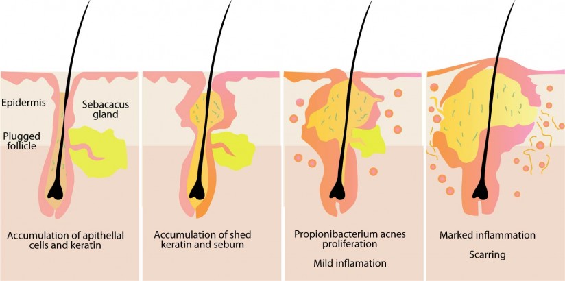 Causes-Of-Acne