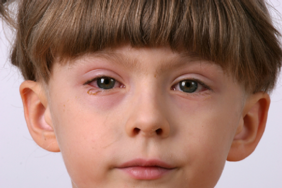 1.-Eyelid-Inflammation-Or-Blepharitis