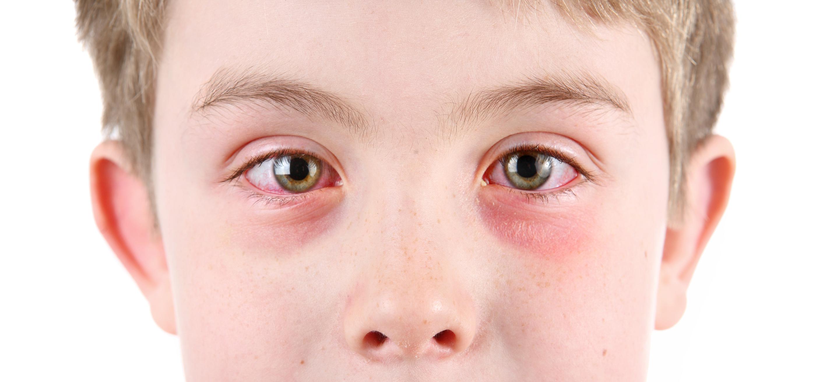 5.-Food--Animal-Or-Environmental-Allergies--Allergic-Conjunctivitis-