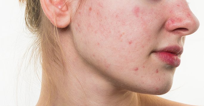 Signs---Symptoms-In-Different-Forms-Of-Rosacea