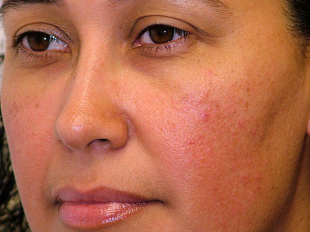 Subtypes-Of-Rosacea