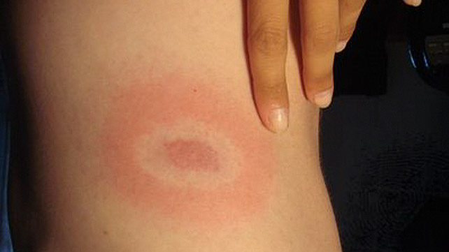 Lyme Disease Symptoms Prevention Diagnosis And Treatment