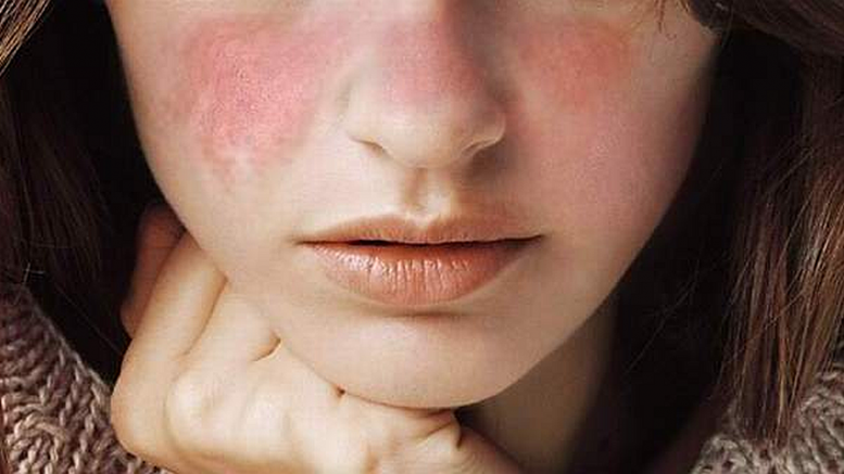 Lupus: Causes, Symptoms, Diagnosis & Treatment