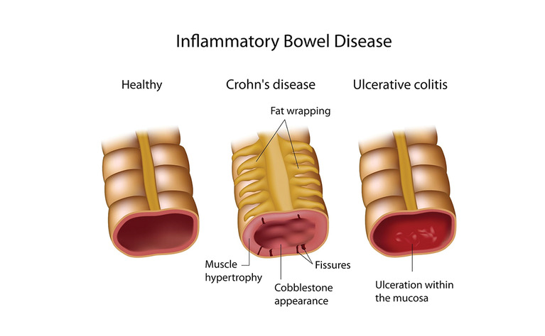 Diagnosing-IBD