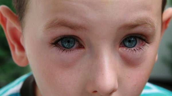 Diagnosis-of-Allergic-Conjunctivitis