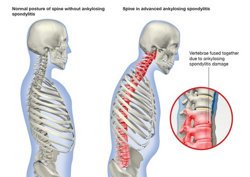 Diagnosis-of-Bechterew-s-Disease