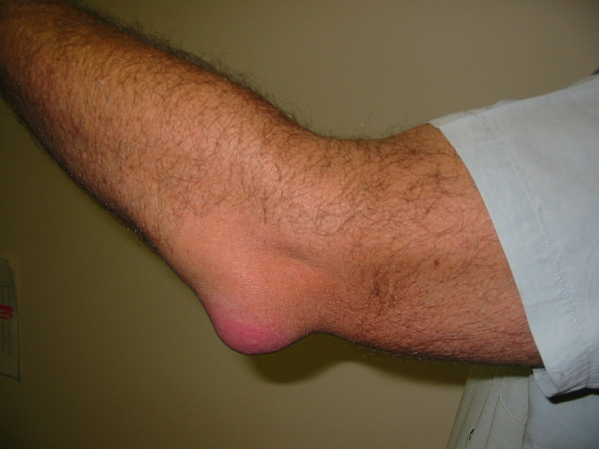 Different-Types-Of-Bursitis