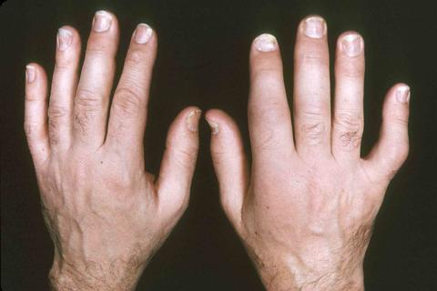 Different-Types-Of-Psoriatic-Arthritis