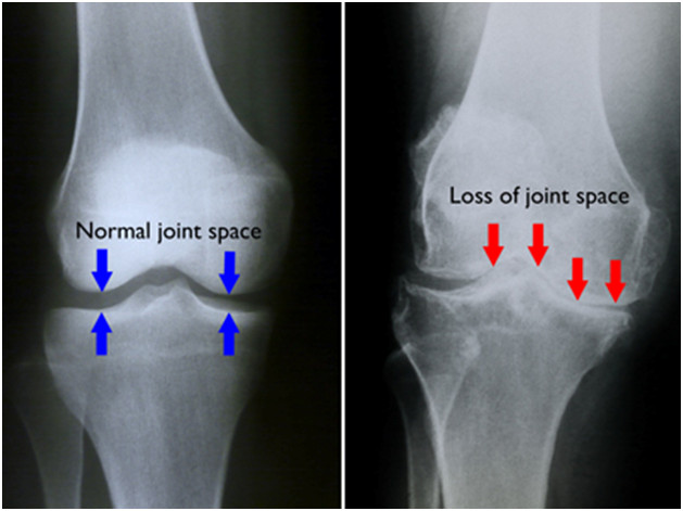 How-To-Diagnose-If-You-Have-Arthritis-Of-The-Knee-