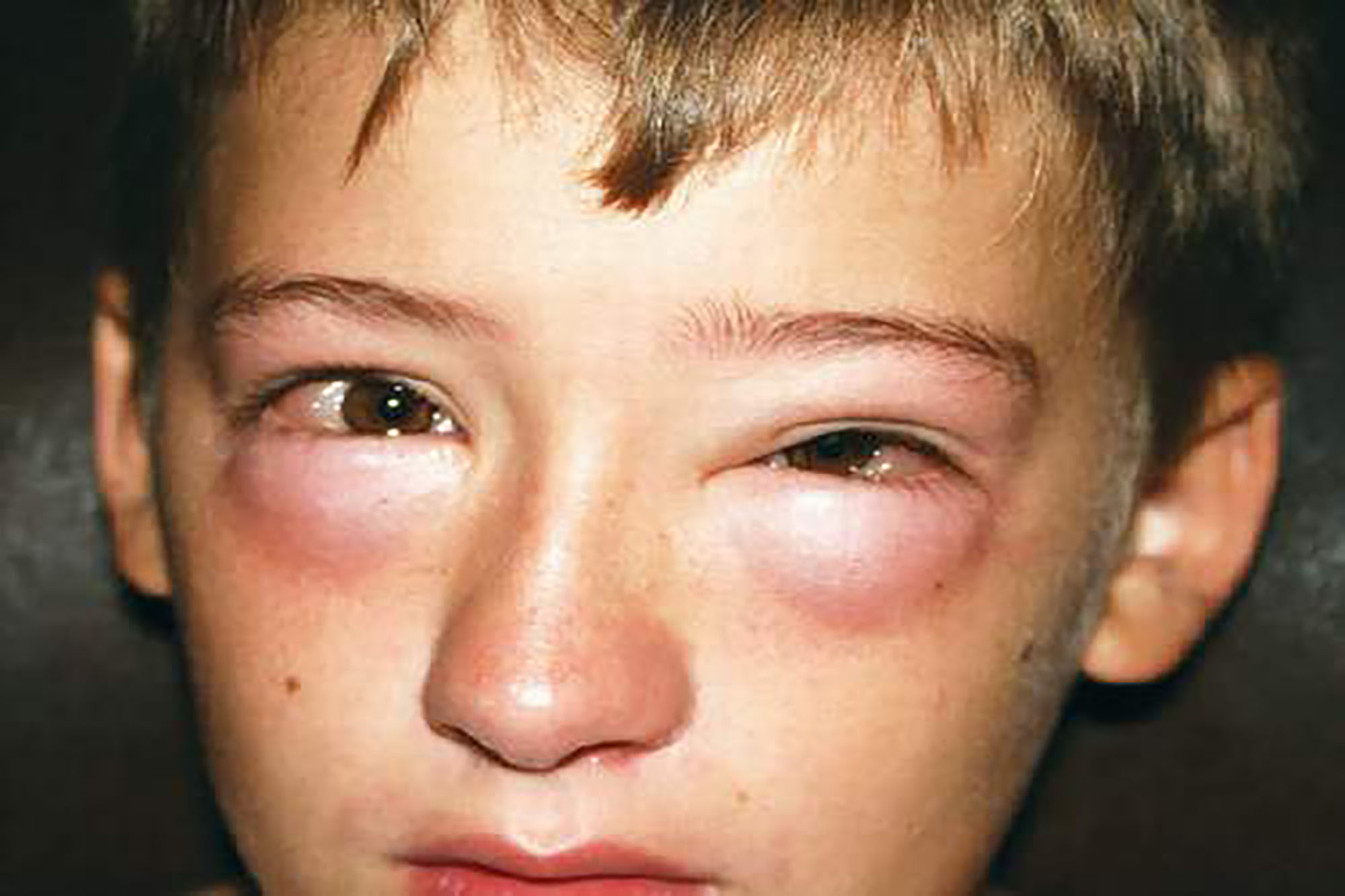 Anaphylaxis Common Triggers, Symptoms, Prevention, Diagnosis & Treatment