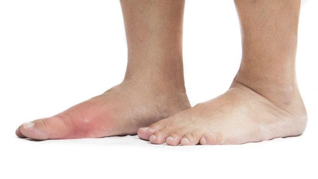 Symptoms---Signs-of-Gout