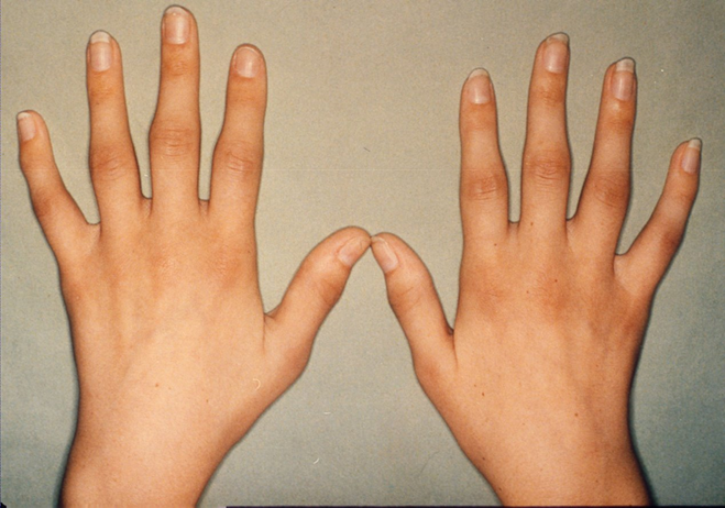 Different-Forms-of-Polyarthritis