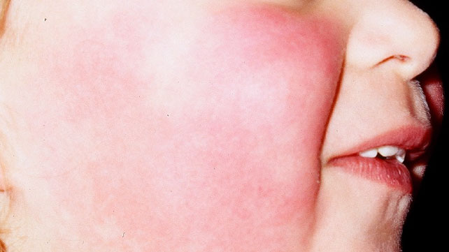 Signs---Symptoms-Of-The-Slapped-cheek-Disease