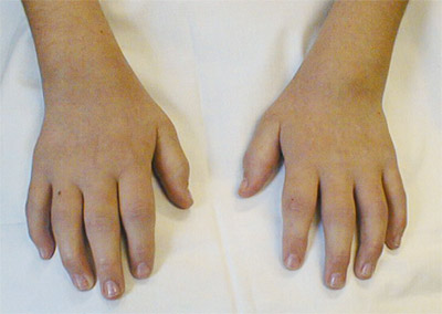 Types-Of-Oligoarthritis-