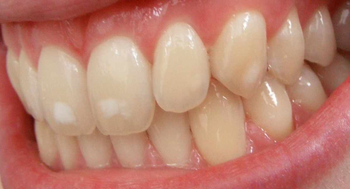 14.-Fluorosis-