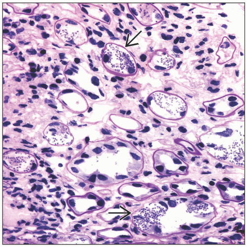 22.-Microsporidiosis