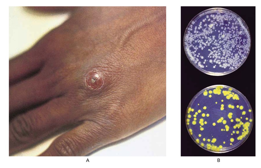 23.-M.-Marinum-Infection--Mycobacterium-Marinum-Infection-