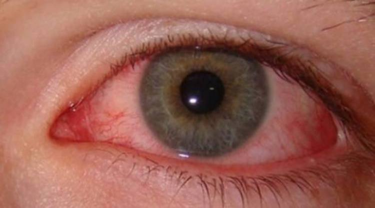 25.-Pink-Eye--Conjunctivitis-