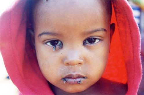 31-Trachoma-
