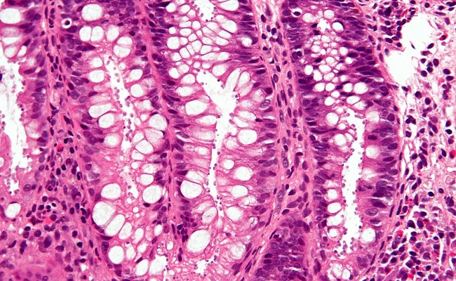 Cryptosporidiosis