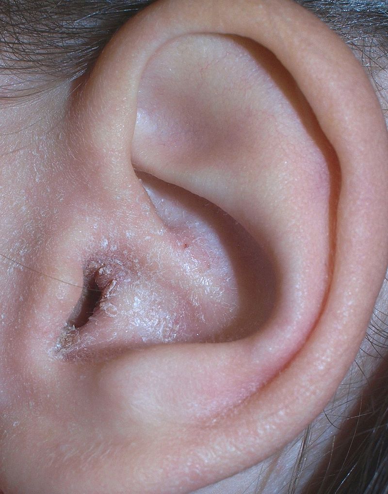 Signs---Symptoms-of-External-Otitis