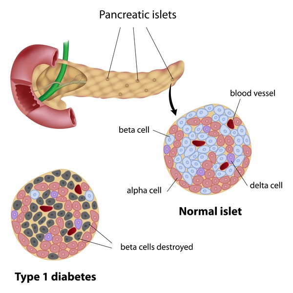 causes of type 1 diabetes research