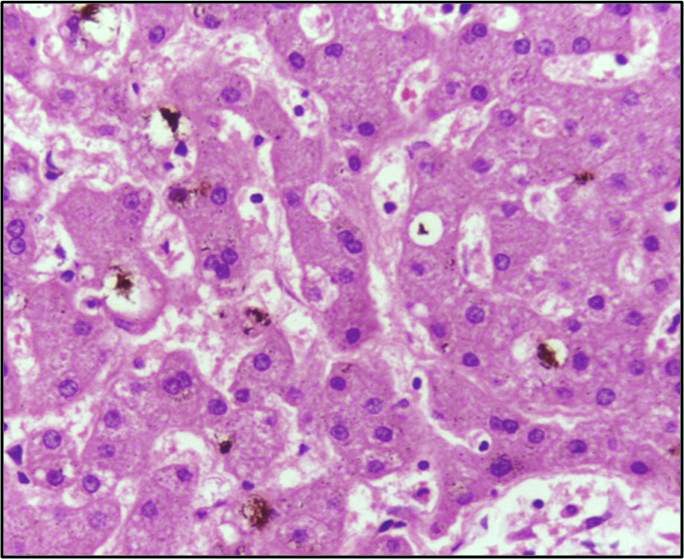 Jaundice Icterus Types Causes Symptoms Diagnosis Treatment And Prevention 