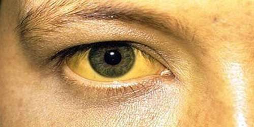 Jaundice (Icterus) Types, Causes, Symptoms, Diagnosis, Treatment ...