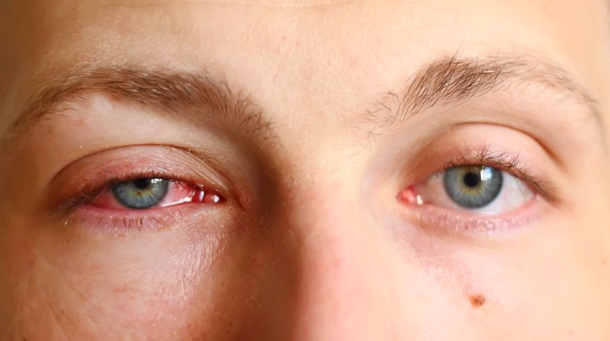 pinkeye-conjunctivitis-signs-causes-diagnosis-treatment-prevention