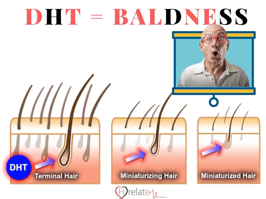 How Does DHT Responsible For Baldness (Androgenic Alopecia): Part 1