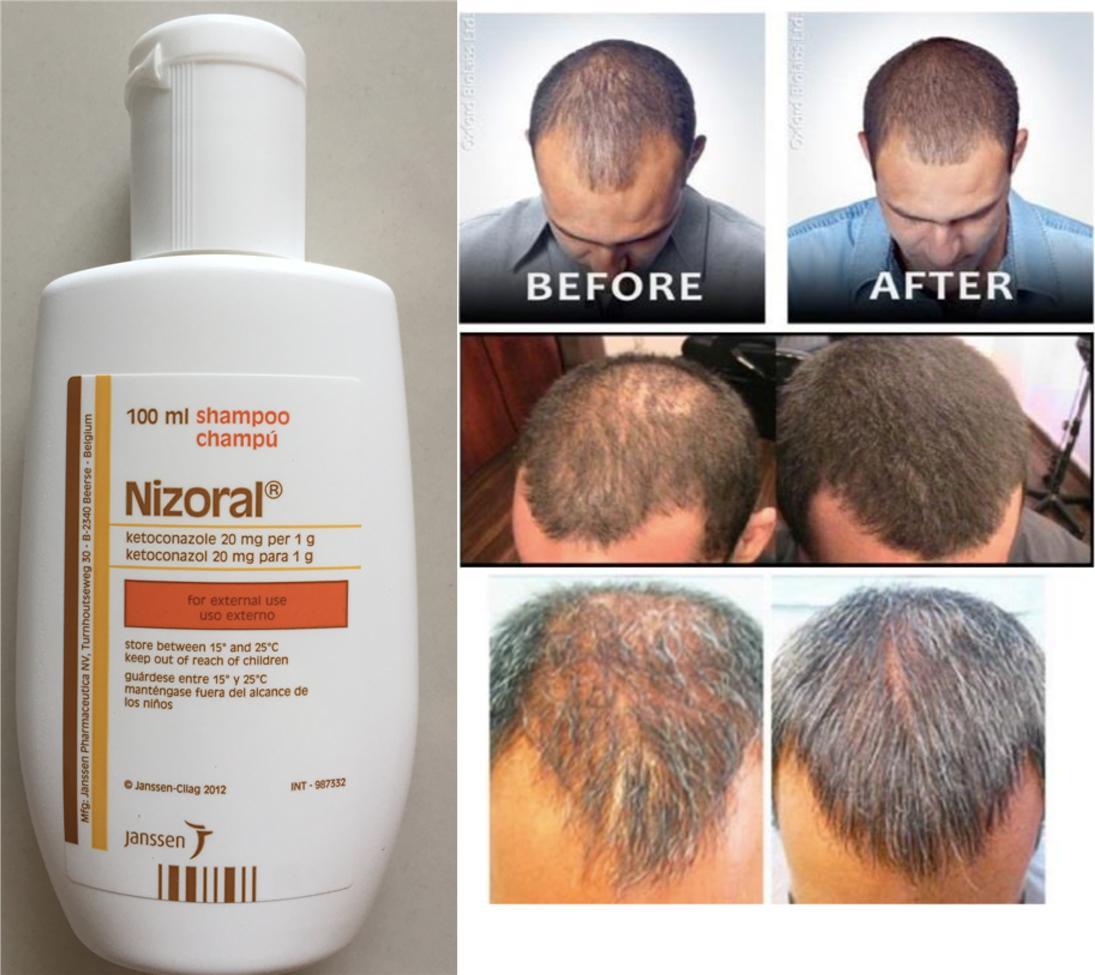 Ketoconazole Shampoo: A Miraculous Anti-dandruff And Hair-Loss Remedy
