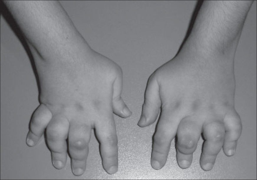 Juvenile Idiopathic Arthritis (JIA) Signs, Subtypes, Cause, Diagnosis & Treatment