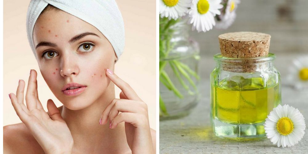 Top 20 Essential Oils for Treating Acne