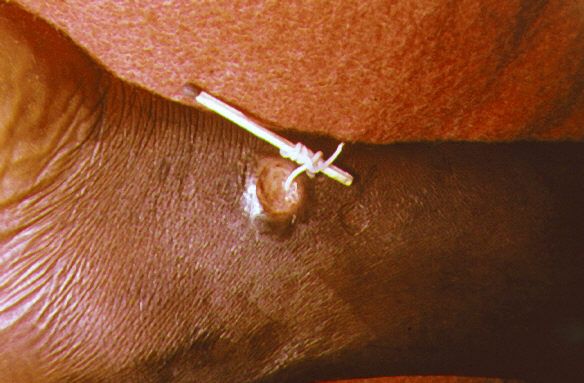 Dracunculiasis (Guinea Worm Disease) Causes, Symptoms, Preventions & Treatment