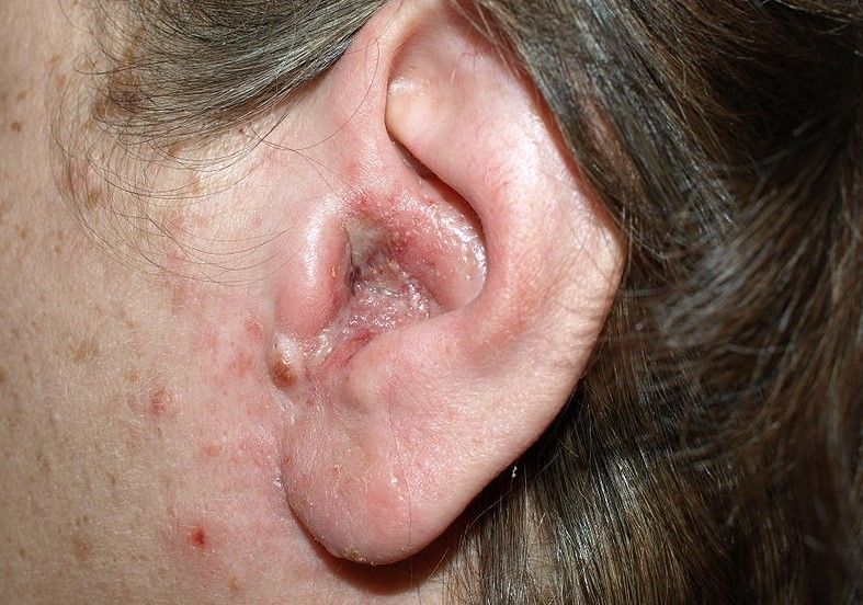 Otitis Externa (Swimmer’s Ear) Causes, Symptoms, Diagnosis & Treatment