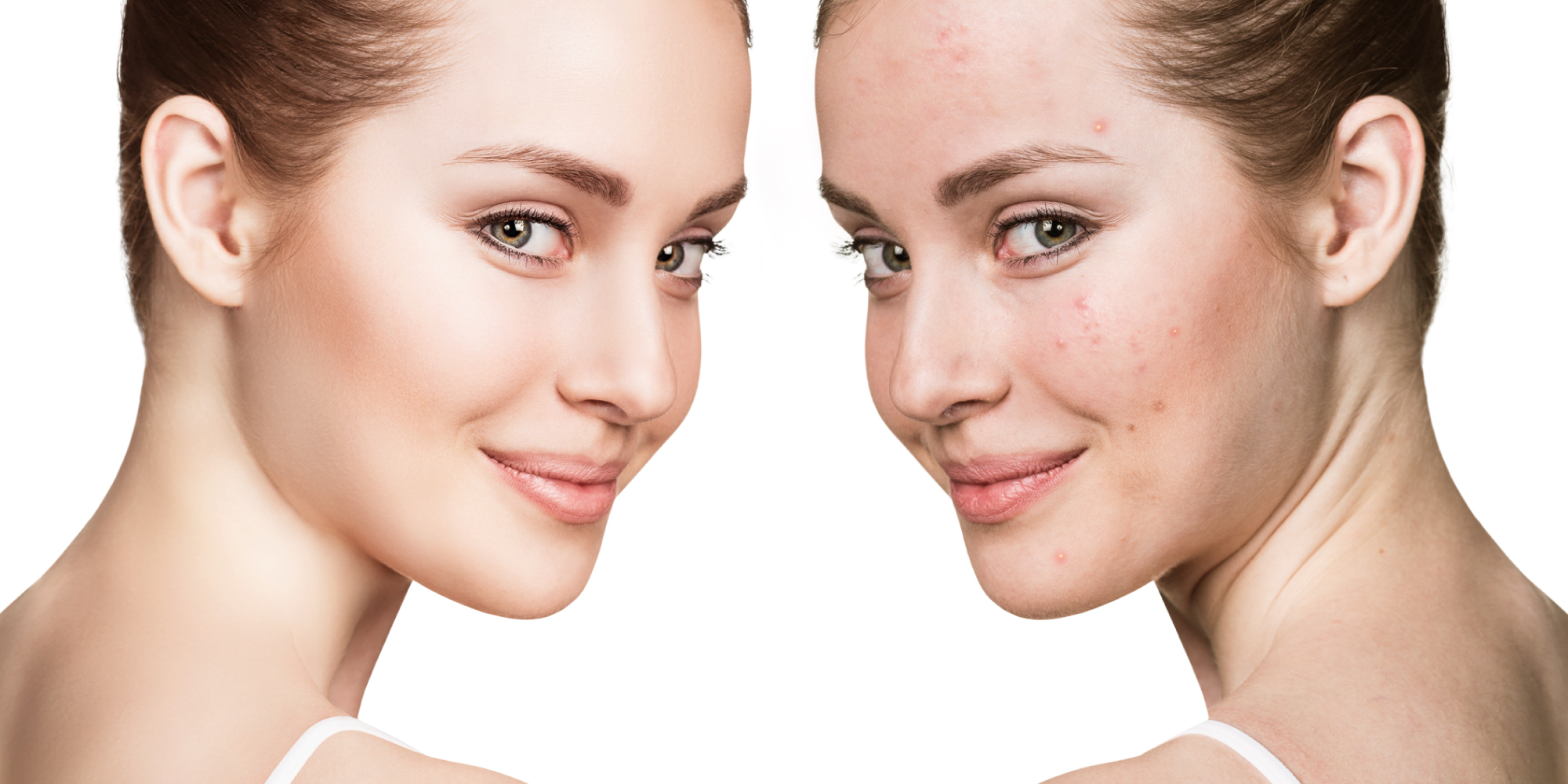 4 Scientifically Proven Forms Of Anti-Androgens That Keep Acne At Bay