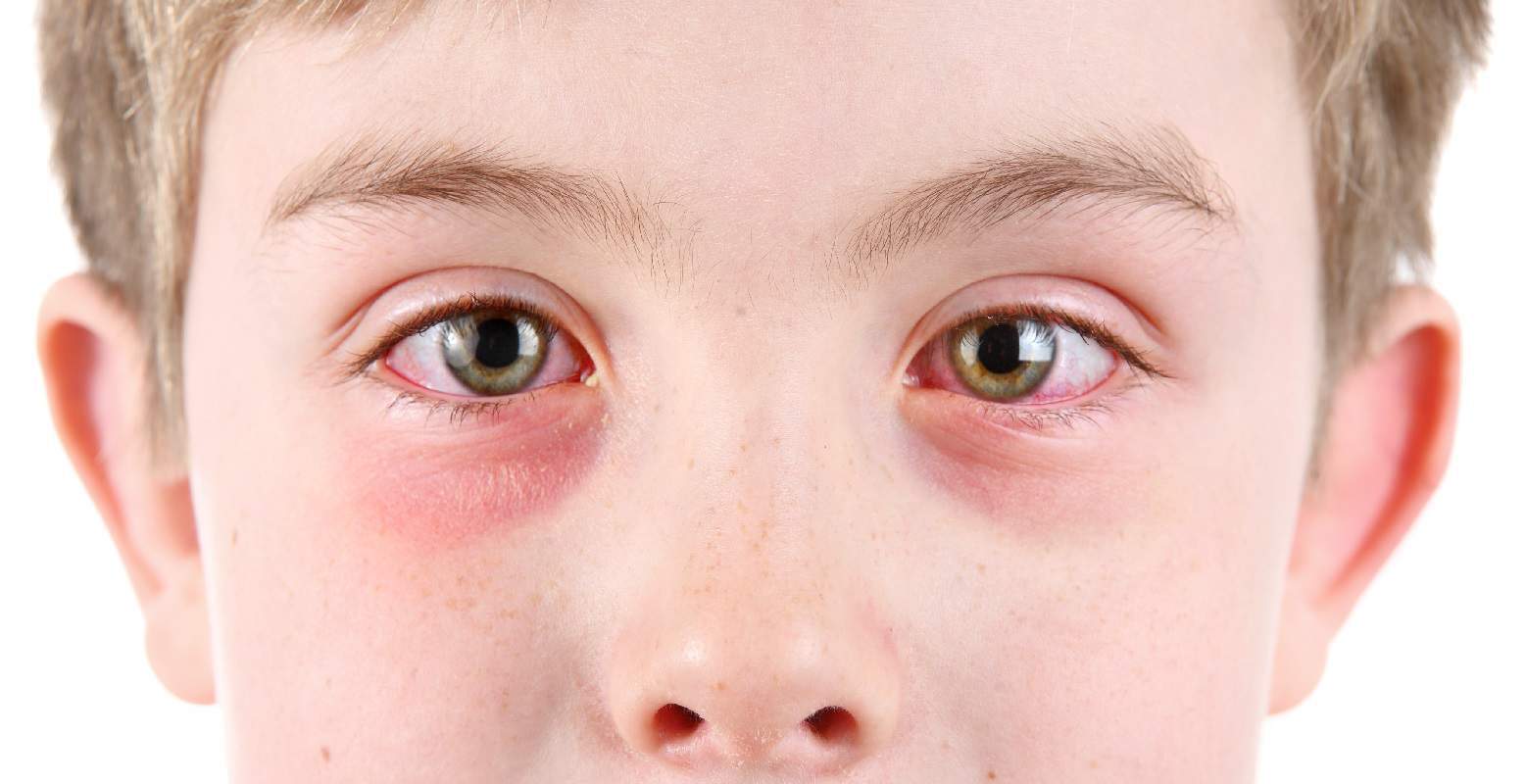 PinkEye(Conjunctivitis): Signs, Causes, Diagnosis, Treatment & Prevention