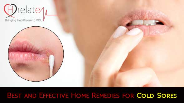 Best and Effective Home Remedies for Cold Sores