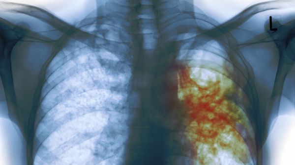 10 Facts That You Should Know About Tuberculosis Right Away