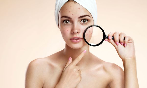 What Is Acne? (Causes, Symptoms, Preventions & Treatments Included)