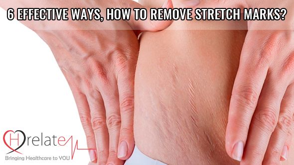 6 Effective Ways On How to Remove Stretch Marks?